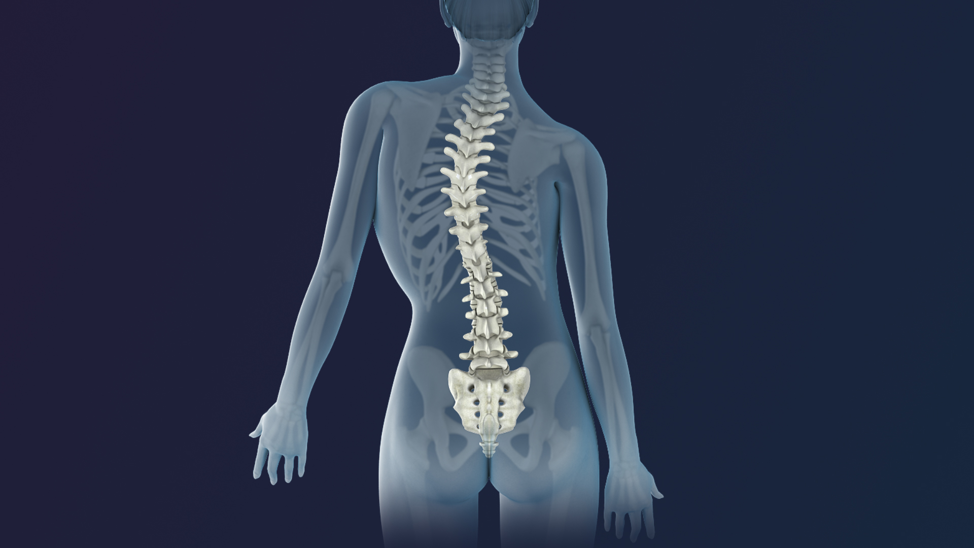 Ilustración de una columna vertebral con escoliosis vista desde la espalda